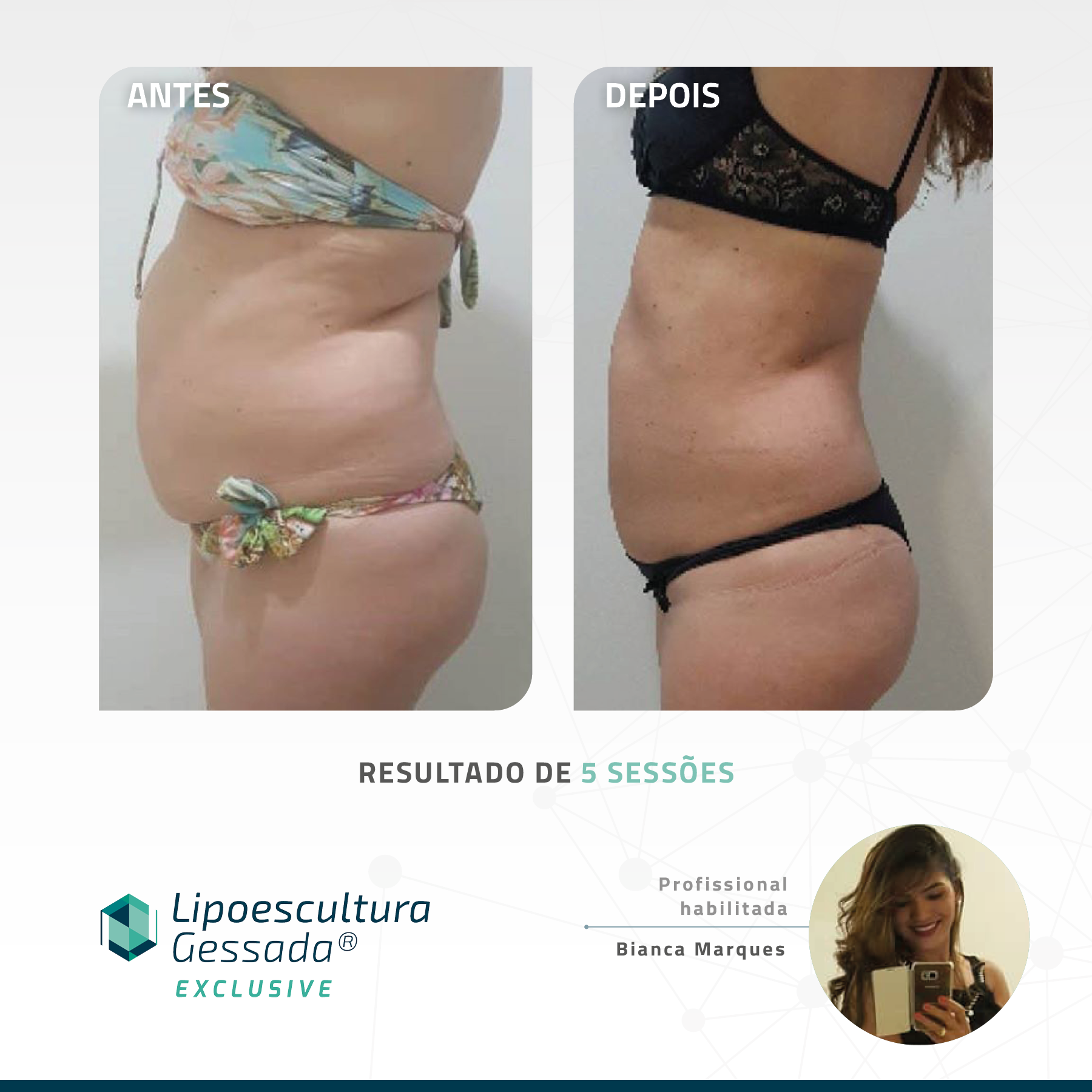 Antes e depois — celulite e gordura localizada por profissional habilitada