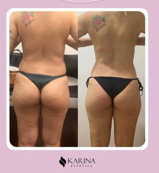 Antes e depois — celulite e gordura localizada por profissional habilitada