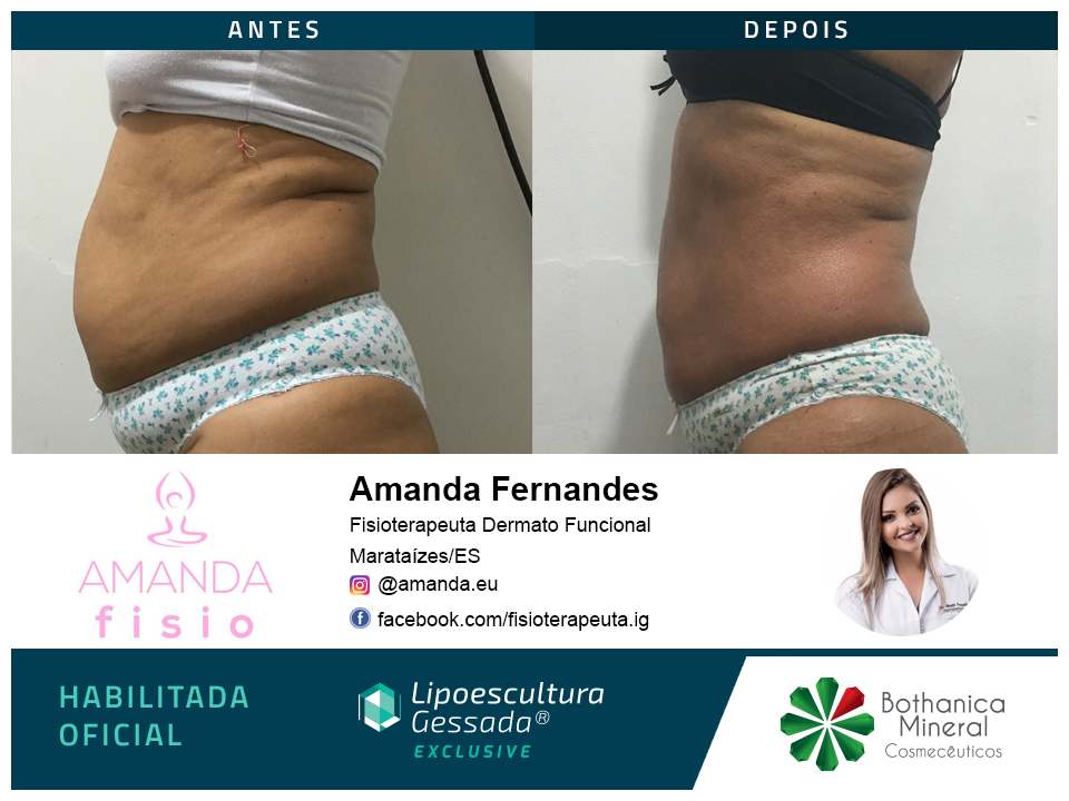 Antes e depois — celulite e gordura localizada por profissional habilitada