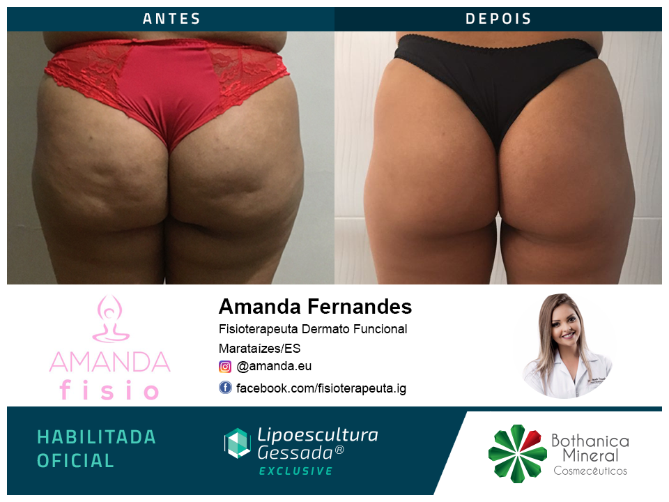 Antes e depois — celulite e gordura localizada por profissional habilitada