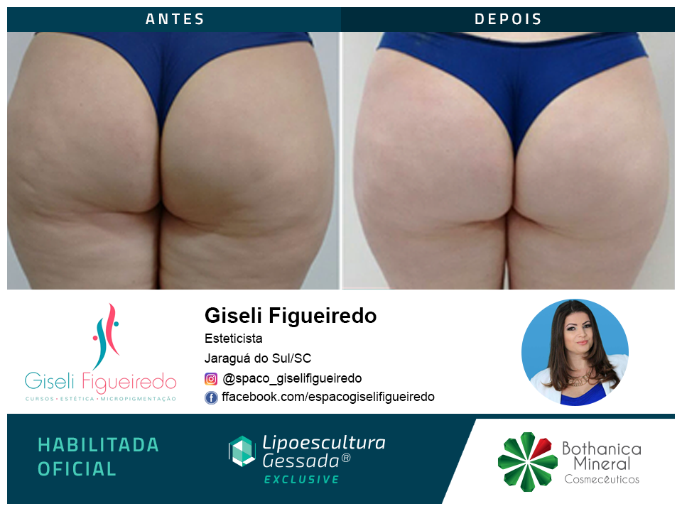 Antes e depois — celulite e gordura localizada por profissional habilitada