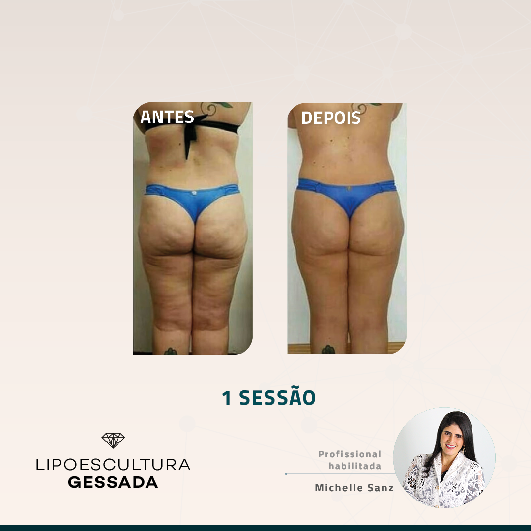 Antes e depois — celulite e gordura localizada por profissional habilitada