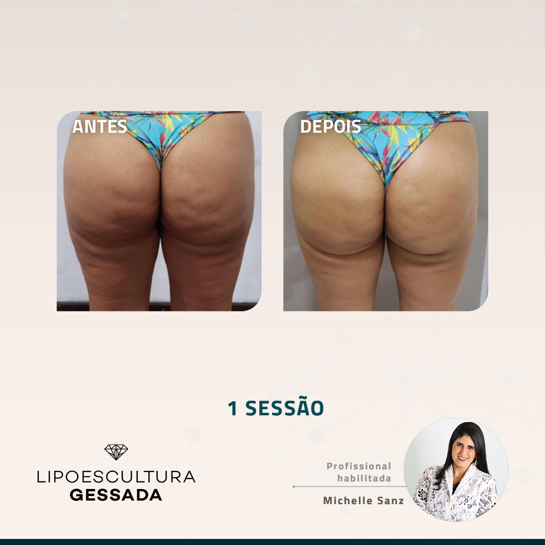 Antes e depois — celulite e gordura localizada por profissional habilitada