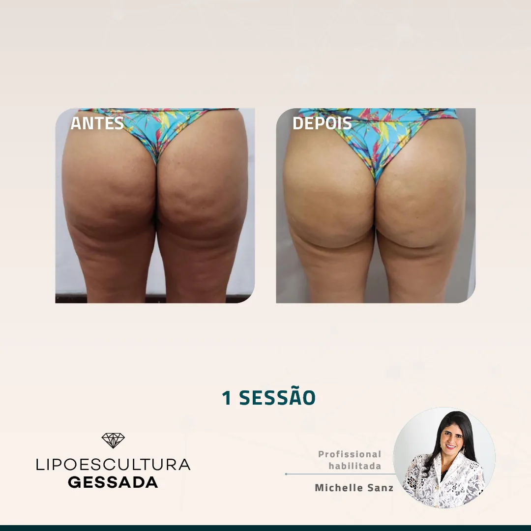 Antes e depois — celulite e gordura localizada por profissional habilitada