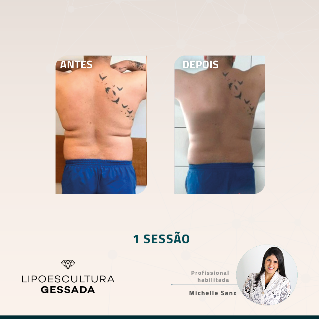 Antes e depois — celulite e gordura localizada por profissional habilitada