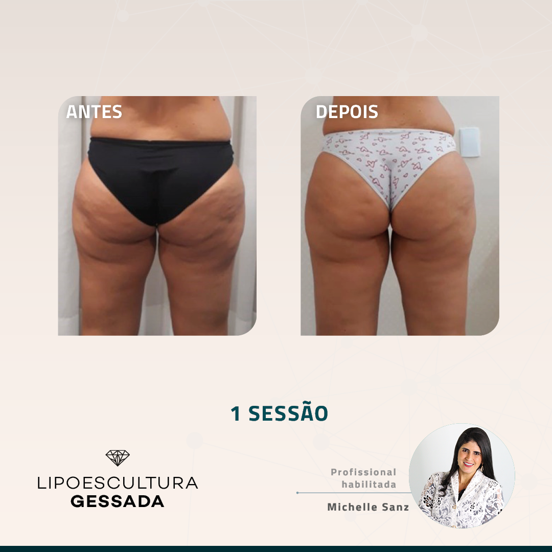 Antes e depois — celulite e gordura localizada por profissional habilitada