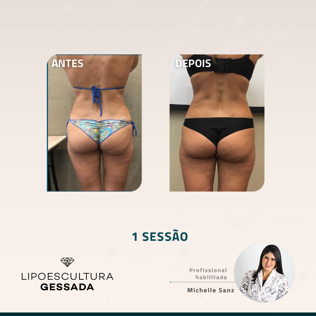 Antes e depois — celulite e gordura localizada por profissional habilitada