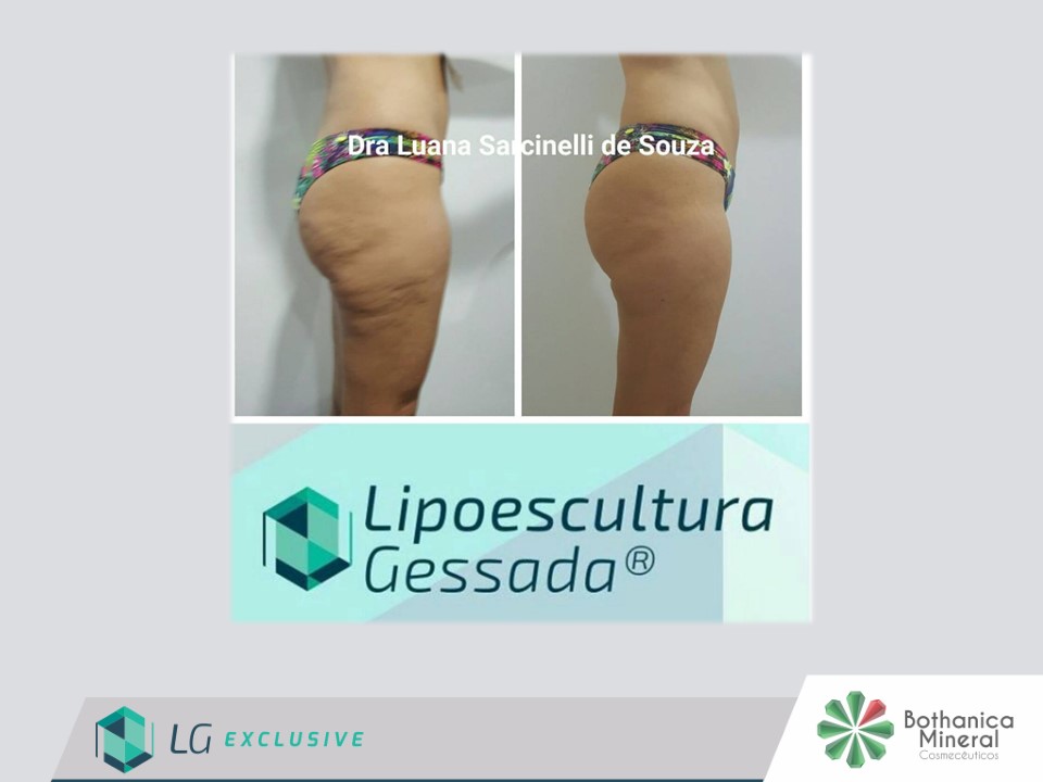 Antes e depois — celulite e gordura localizada por profissional habilitada