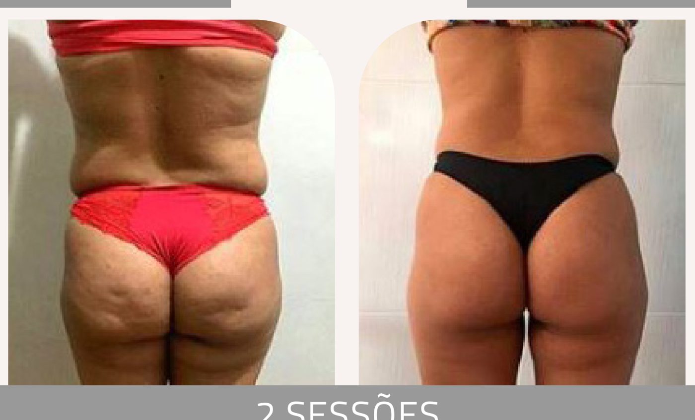 Antes e depois — celulite e gordura localizada por profissional habilitada