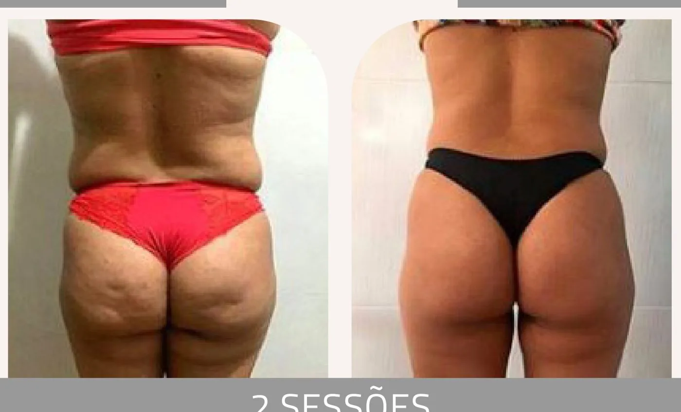 Antes e depois — celulite e gordura localizada por profissional habilitada