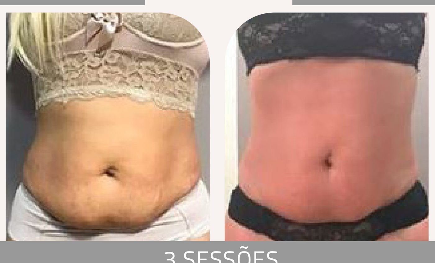 Antes e depois — celulite e gordura localizada por profissional habilitada