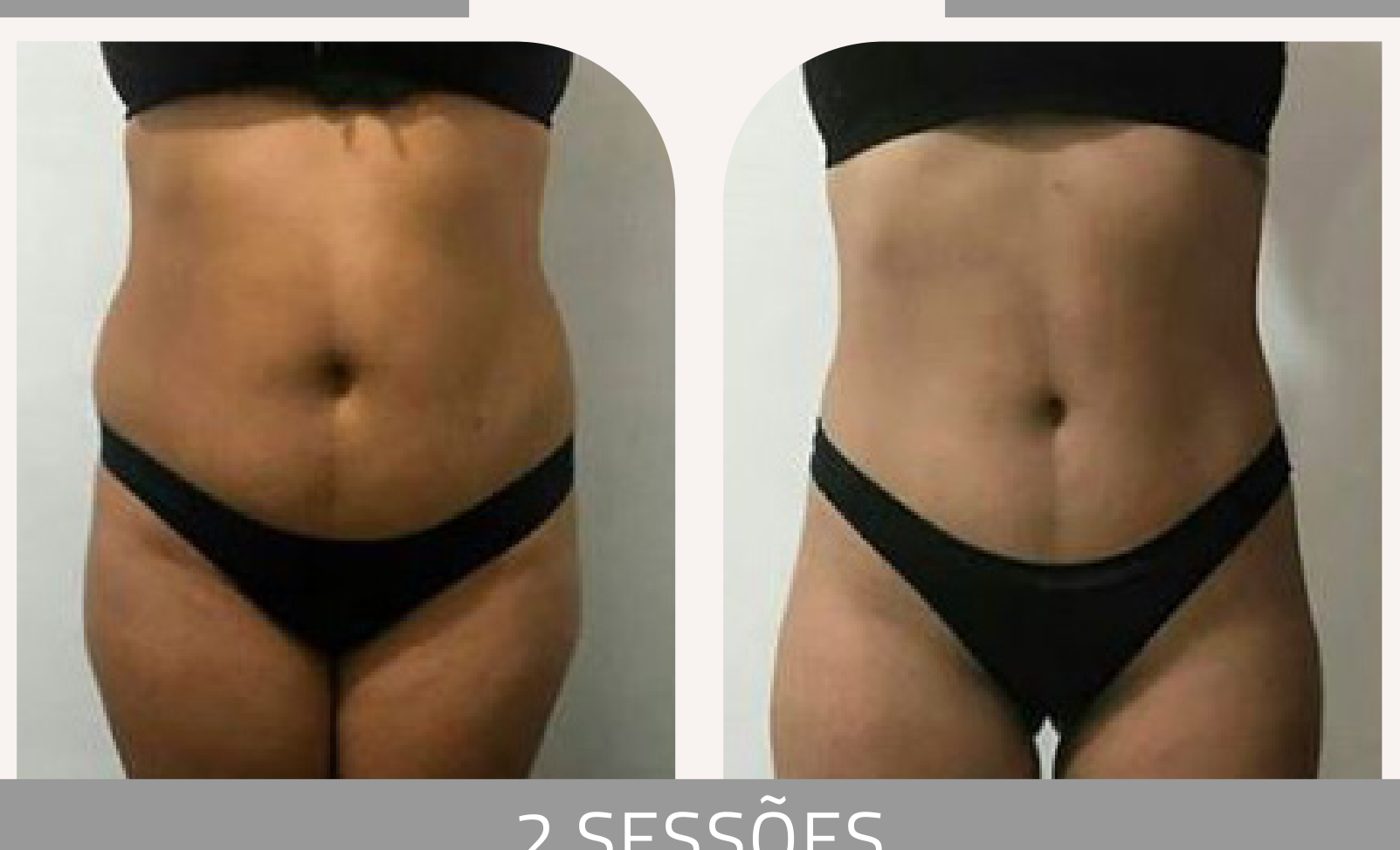 Antes e depois — celulite e gordura localizada por profissional habilitada