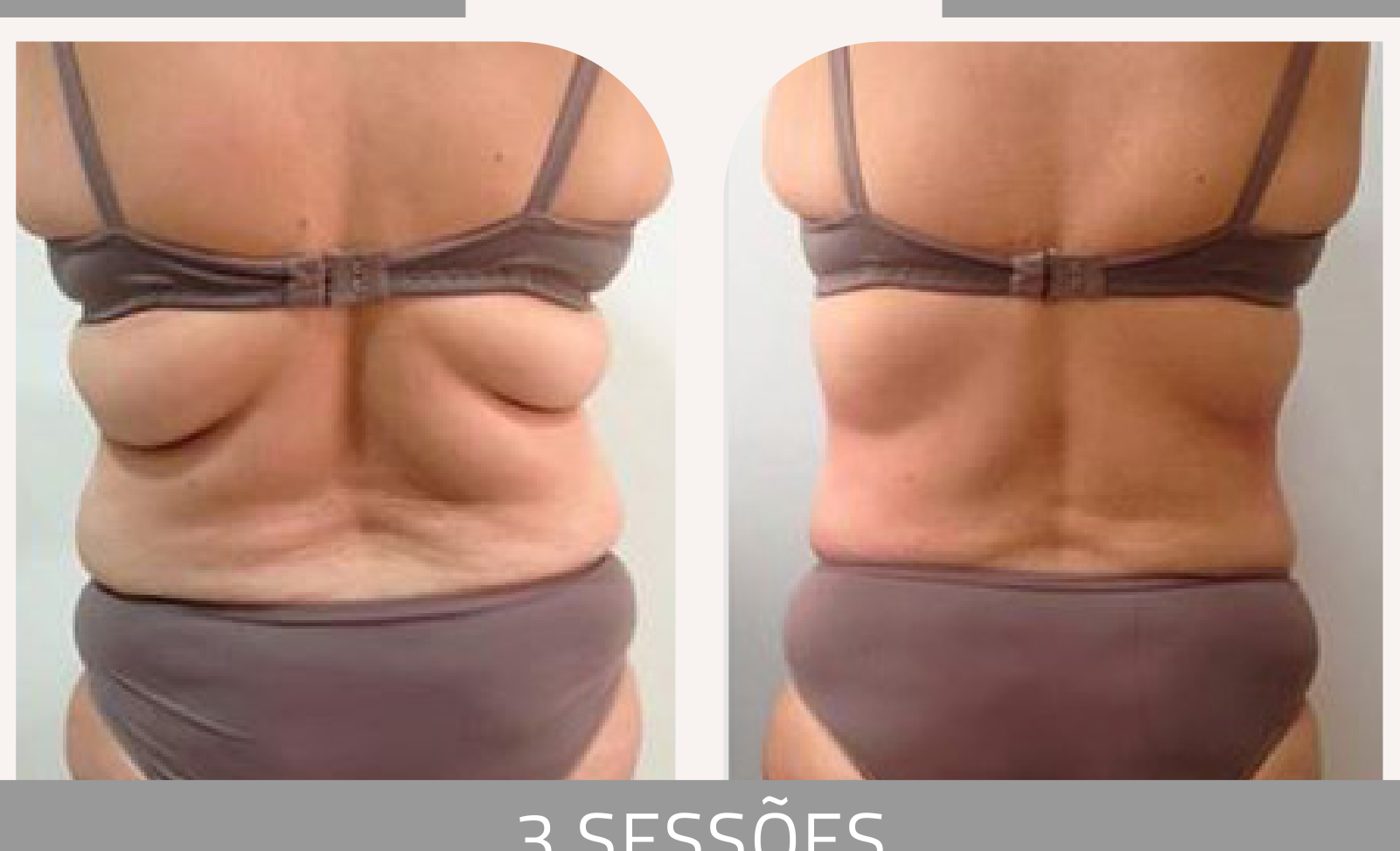 Antes e depois — celulite e gordura localizada por profissional habilitada