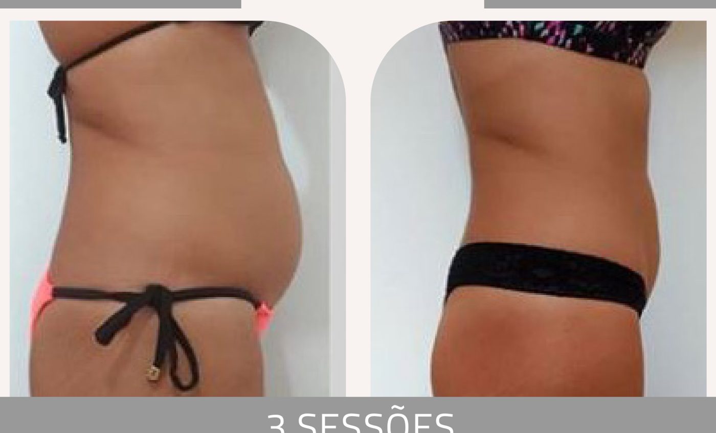 Antes e depois — celulite e gordura localizada por profissional habilitada