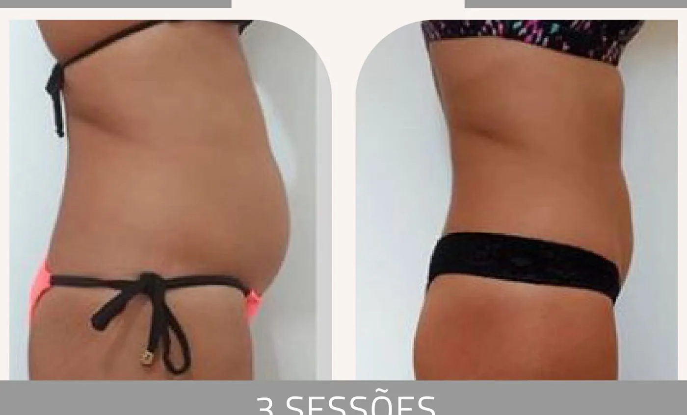 Antes e depois — celulite e gordura localizada por profissional habilitada