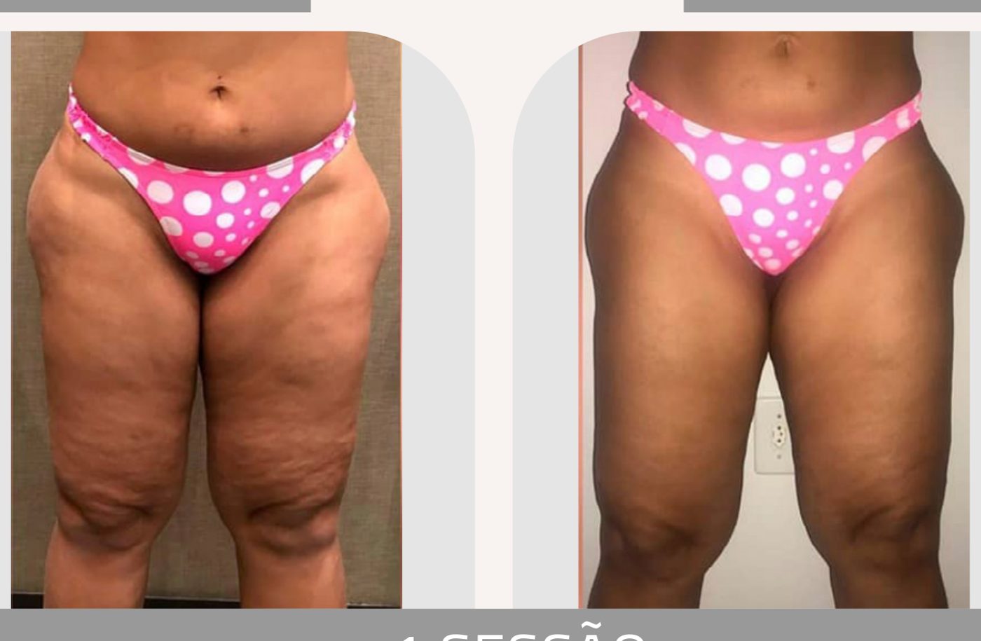 Antes e depois — celulite e gordura localizada por profissional habilitada