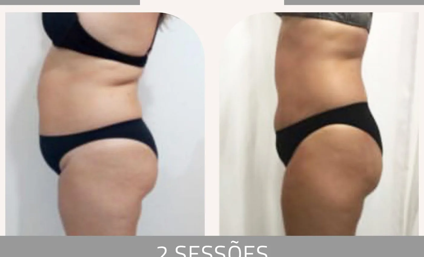 Antes e depois — celulite e gordura localizada por profissional habilitada