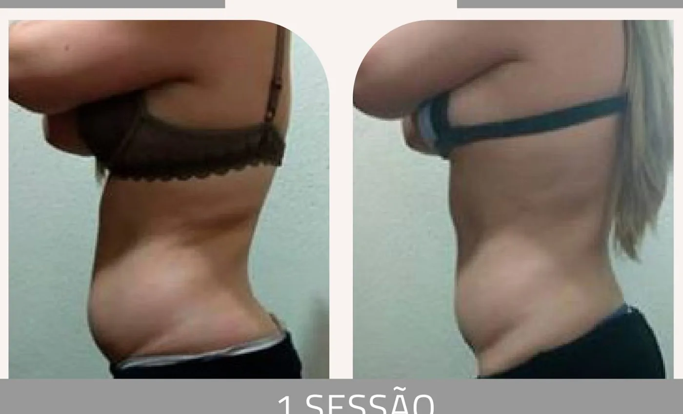 Antes e depois — celulite e gordura localizada por profissional habilitada