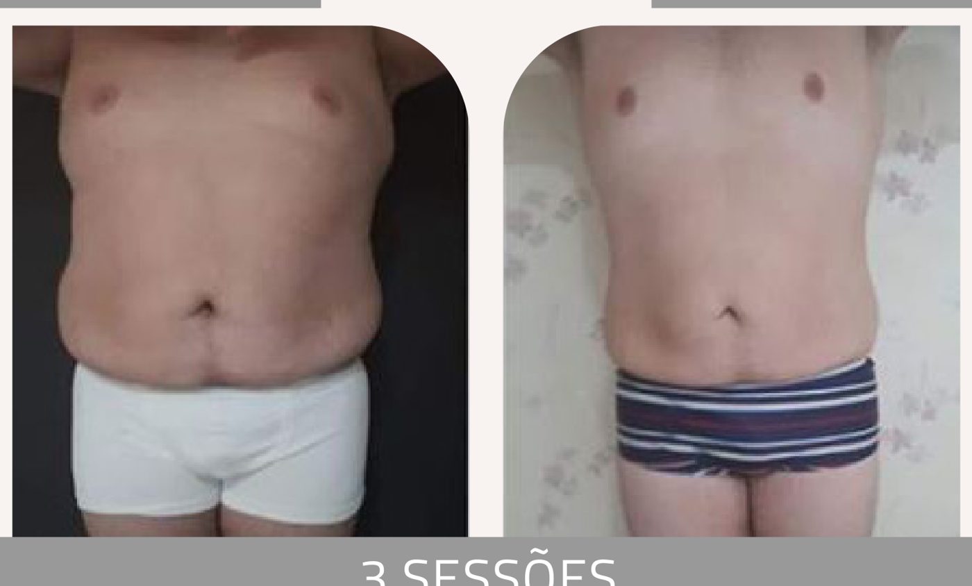 Antes e depois — celulite e gordura localizada por profissional habilitada