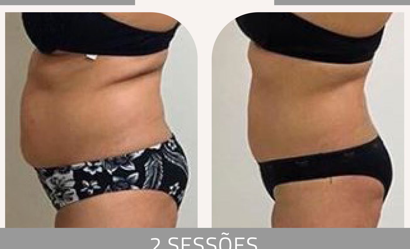 Antes e depois — celulite e gordura localizada por profissional habilitada