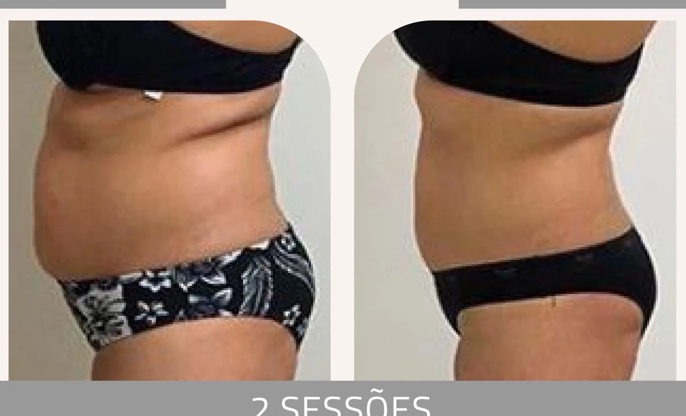 Antes e depois — celulite e gordura localizada por profissional habilitada