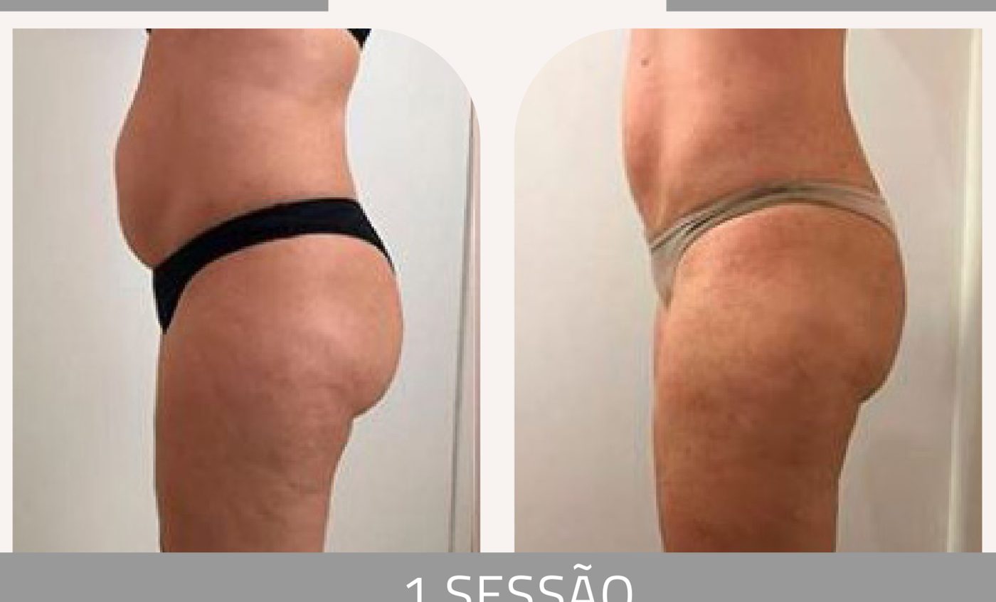 Antes e depois — celulite e gordura localizada por profissional habilitada