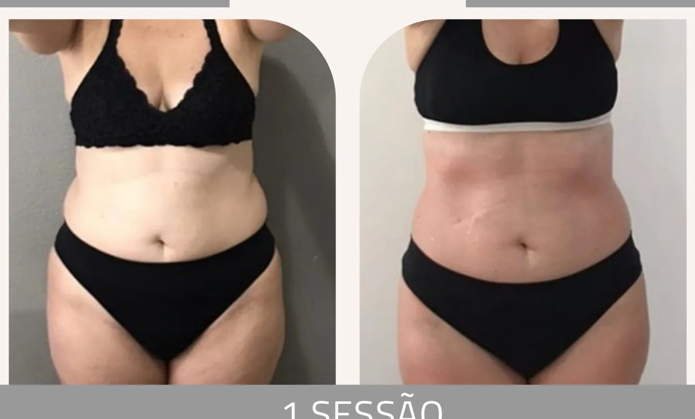 Antes e depois — celulite e gordura localizada por profissional habilitada