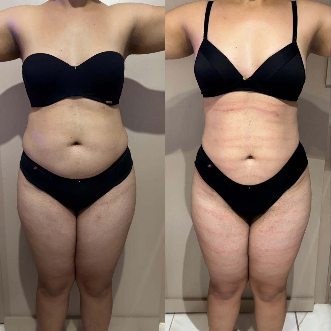 Antes e depois — detox e emagrecimento por profissional habilitada