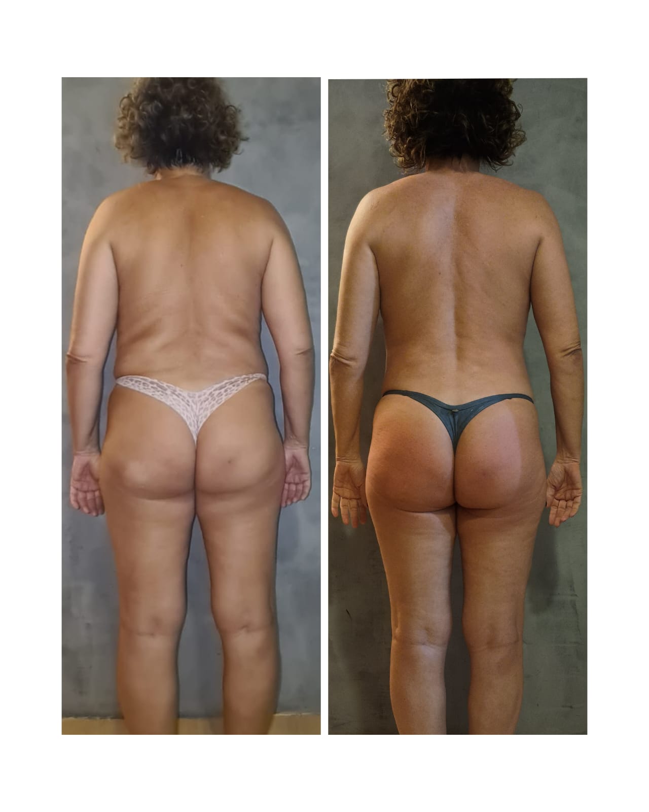 Antes e depois — detox e emagrecimento por profissional habilitada
