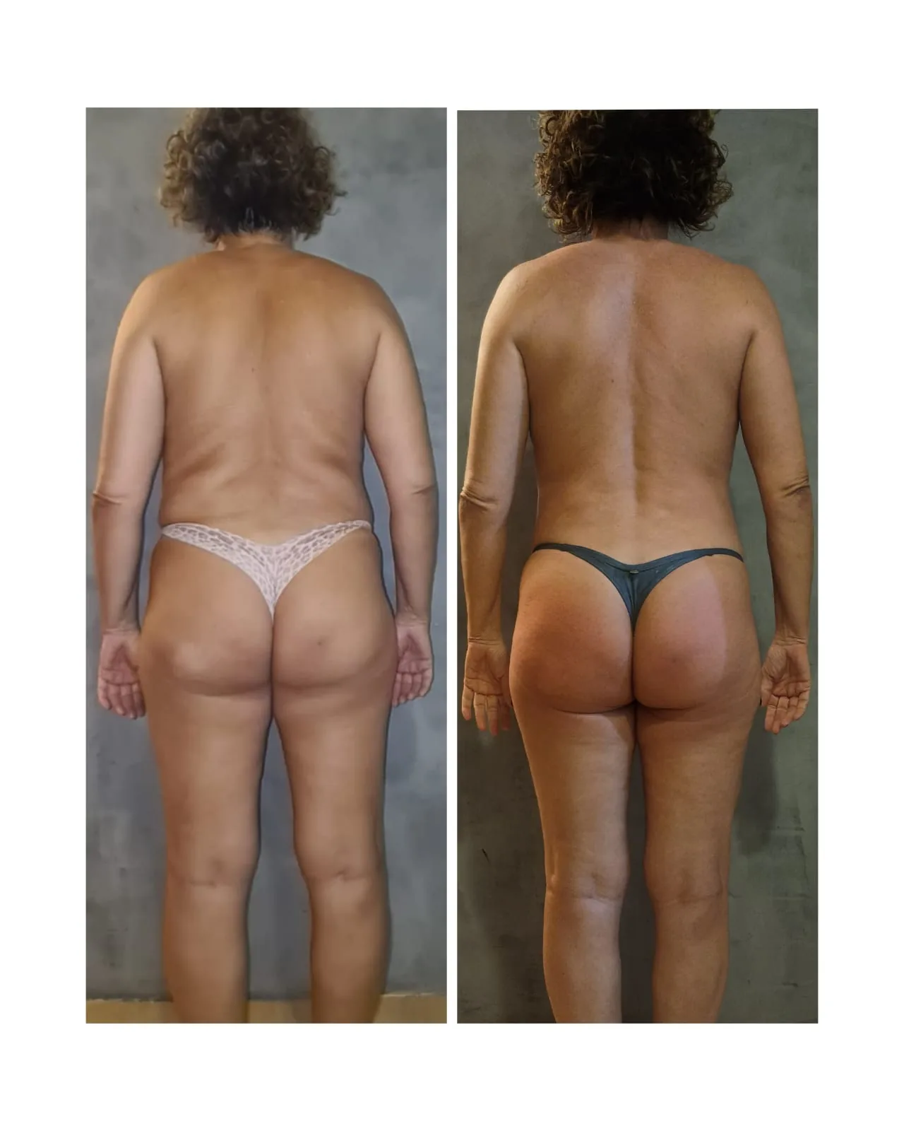 Antes e depois — detox e emagrecimento por profissional habilitada