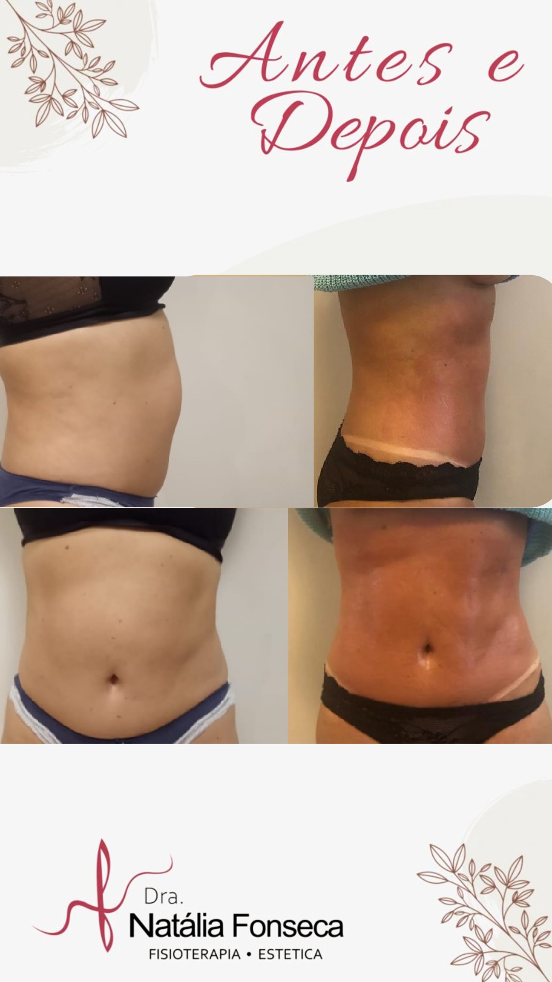 Antes e depois — detox e emagrecimento por profissional habilitada