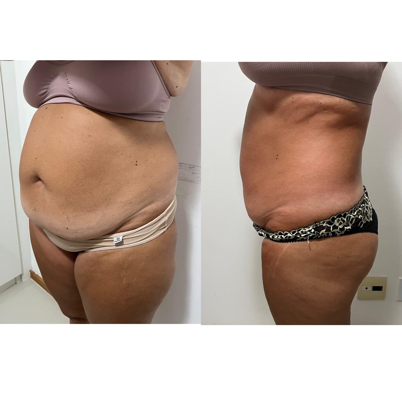 Antes e depois — detox e emagrecimento por profissional habilitada