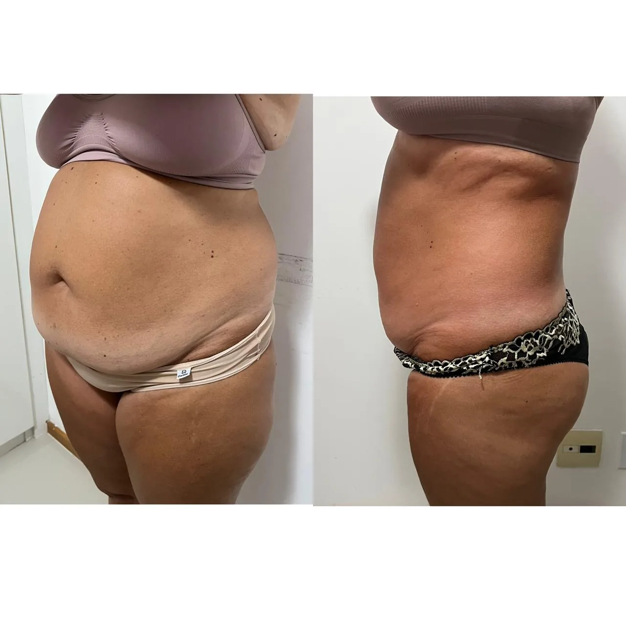Antes e depois — detox e emagrecimento por profissional habilitada