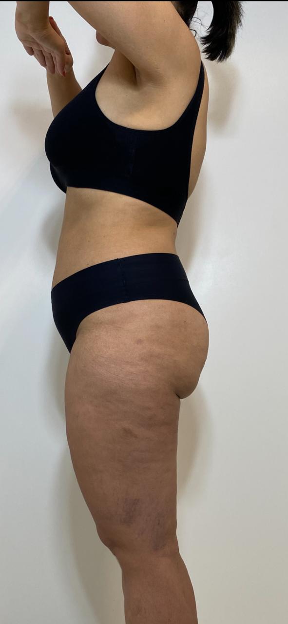 Antes e depois — detox e emagrecimento por profissional habilitada