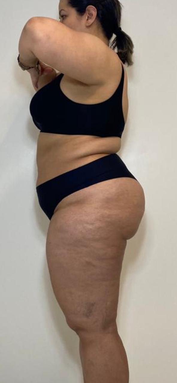 Antes e depois — detox e emagrecimento por profissional habilitada