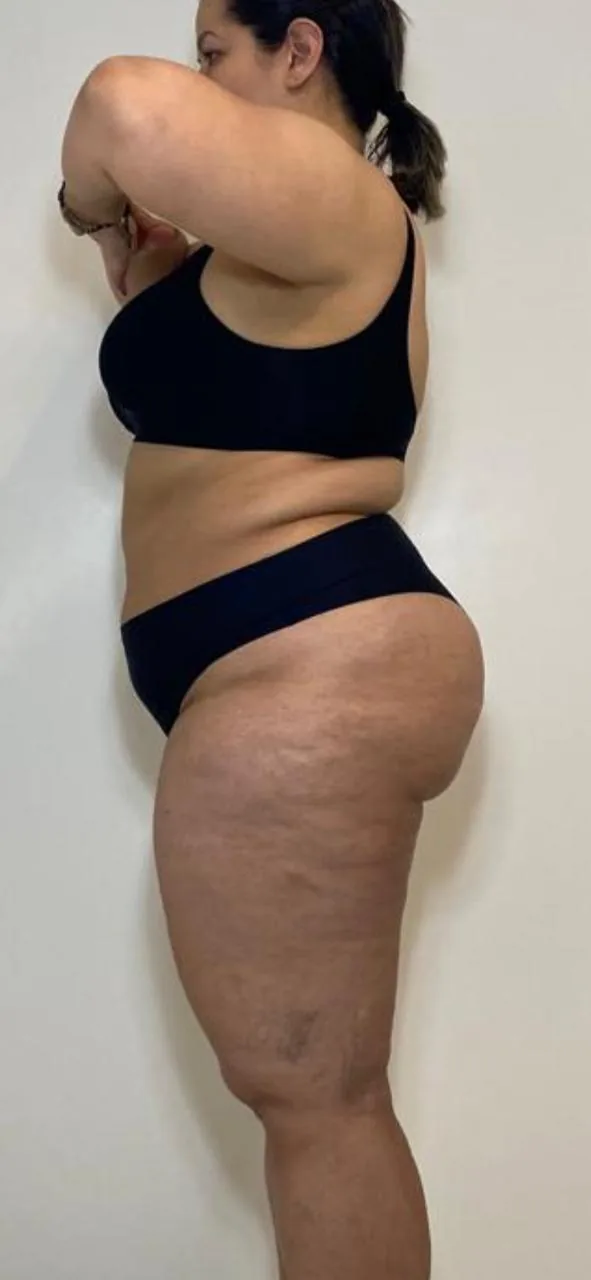 Antes e depois — detox e emagrecimento por profissional habilitada