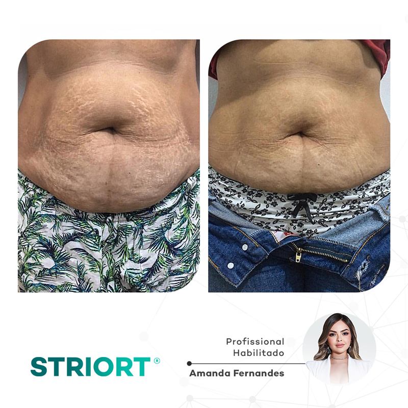Antes e depois — tratamento de estrias por profissional habilitada
