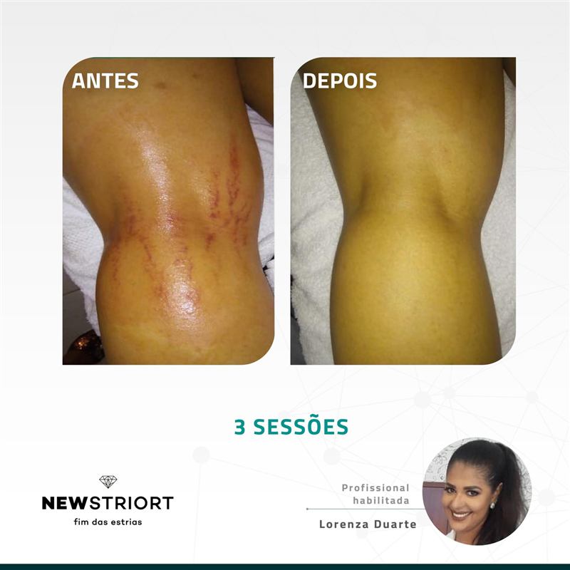 Antes e depois — tratamento de estrias por profissional habilitada