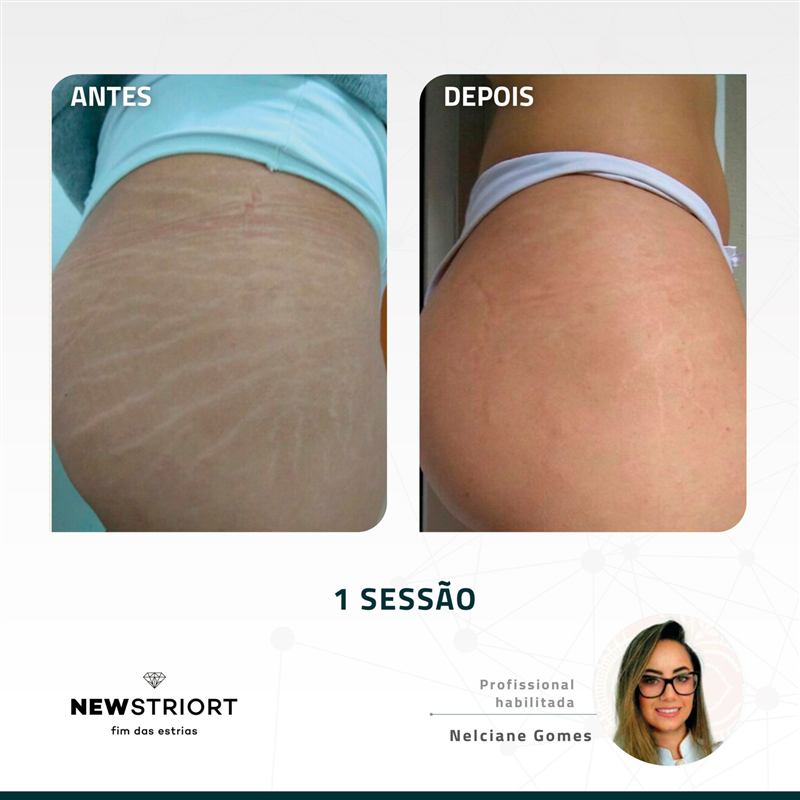 Antes e depois — tratamento de estrias por profissional habilitada