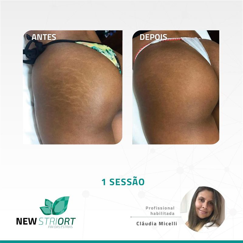 Antes e depois — tratamento de estrias por profissional habilitada