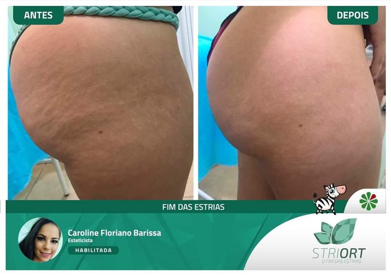 Antes e depois — tratamento de estrias por profissional habilitada