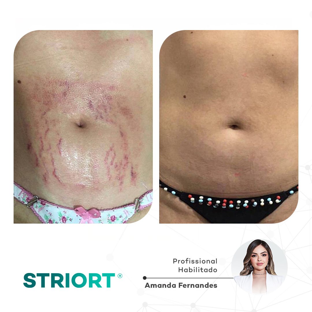 Antes e depois — tratamento de estrias por profissional habilitada
