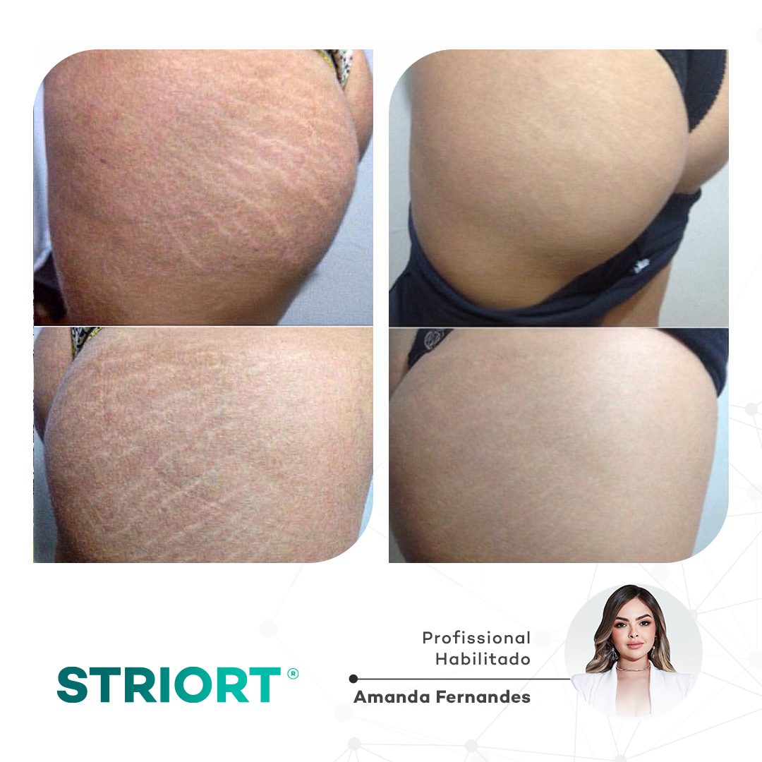 Antes e depois — tratamento de estrias por profissional habilitada