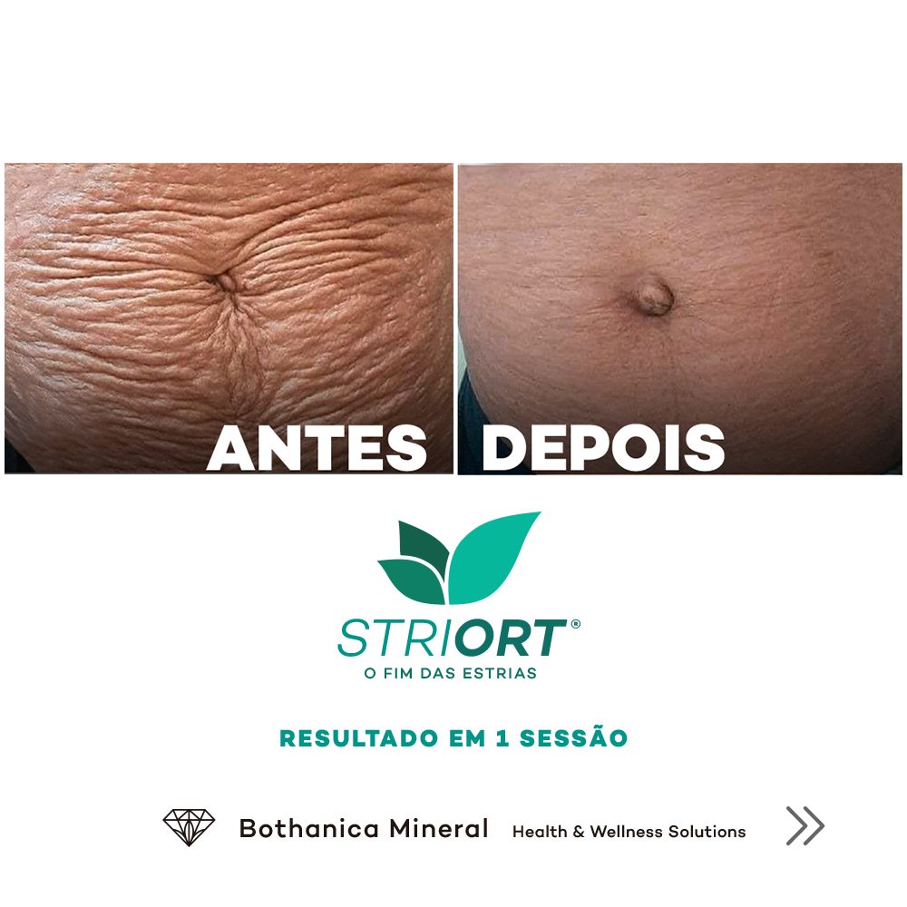 Antes e depois — tratamento de estrias por profissional habilitada