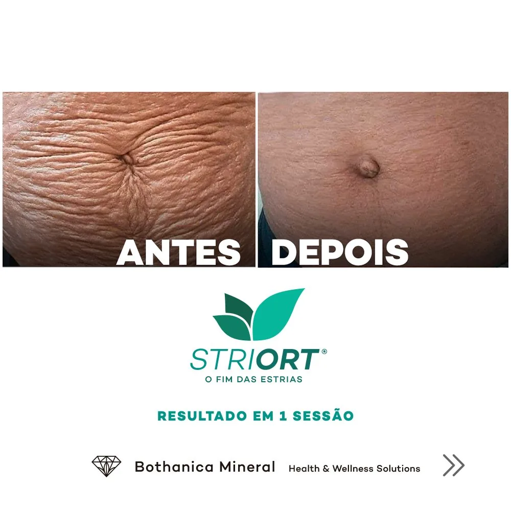 Antes e depois — tratamento de estrias por profissional habilitada