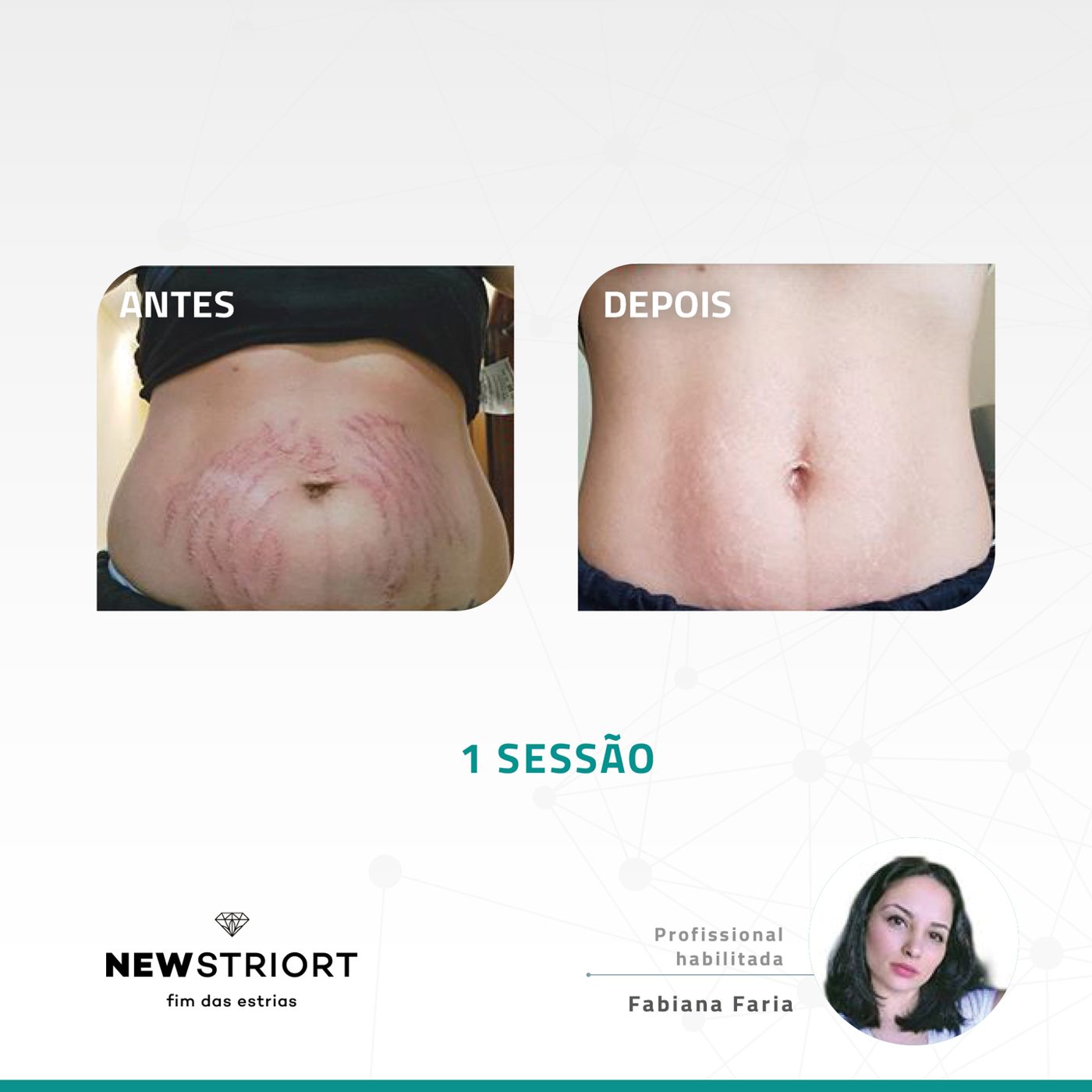 Antes e depois — tratamento de estrias por profissional habilitada