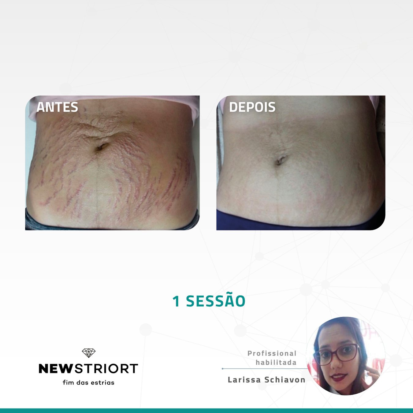 Antes e depois — tratamento de estrias por profissional habilitada
