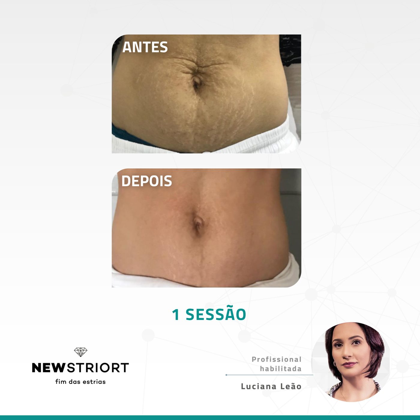 Antes e depois — tratamento de estrias por profissional habilitada