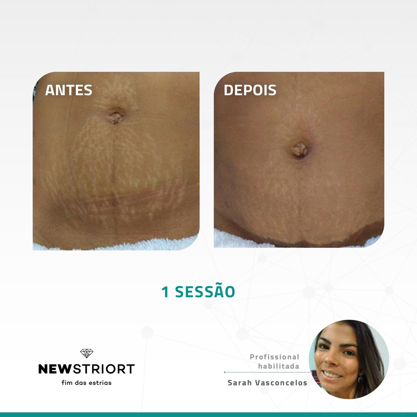 Antes e depois — tratamento de estrias por profissional habilitada