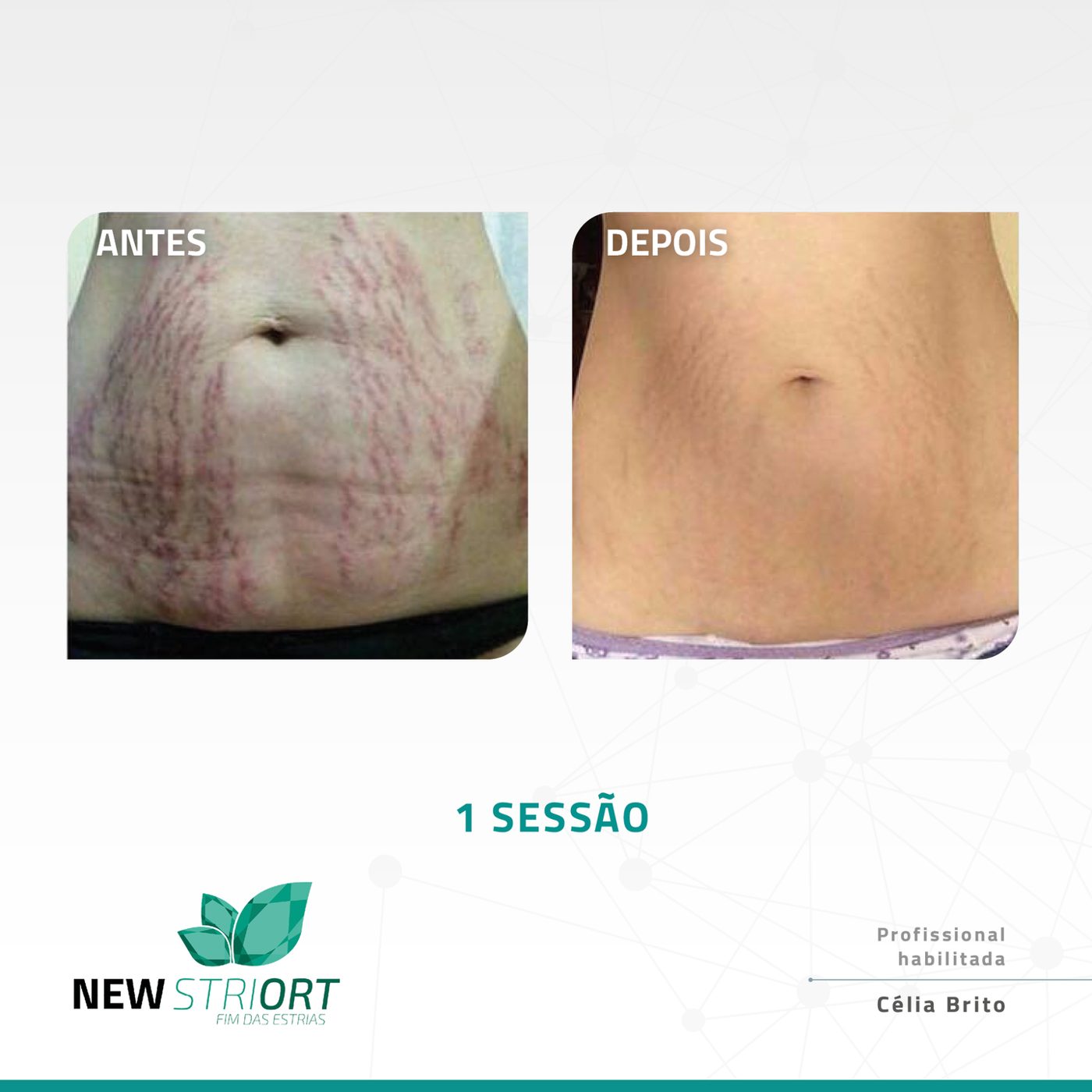 Antes e depois — tratamento de estrias por profissional habilitada